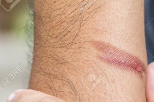 Introdução a camuflagem de cicatriz